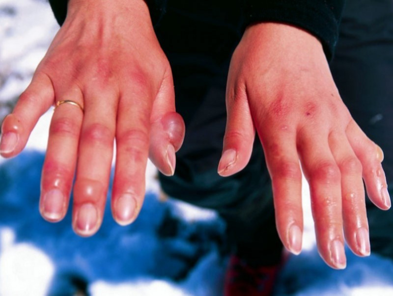 Хөлдөлт, осголтоос сэргийлье